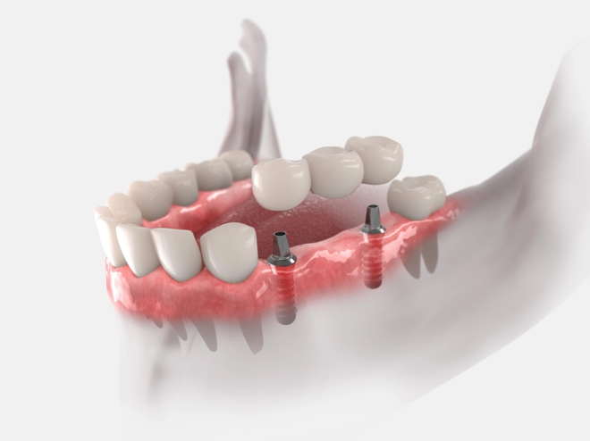 Ersatz einer Zahnreihe mit Implantaten bei Zahnarzt Köln Innenstadt Dr. Sales
