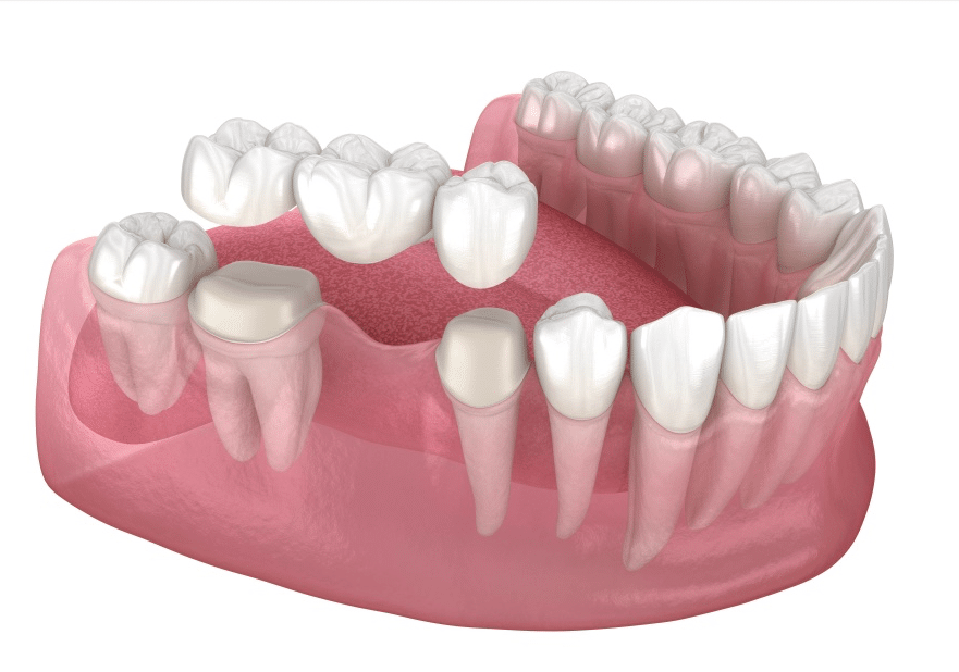 Ersetzen eines fehlenden Zahnes mit einer Brücke - Zahnarzt Köln Zentrum Dr. Sales