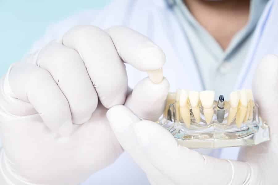 Implantate Köln - Zahnimplantate bei Zahnarzt Köln Zentrum Dr. Sales - Implantologie