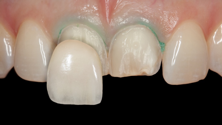 Veneers Köln zur Korrektur von optischen Mängeln an den Zähnen