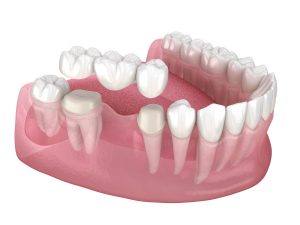 Zahnbrücken Köln - eine stabile Verbindung zwischen gesunden Zähnen