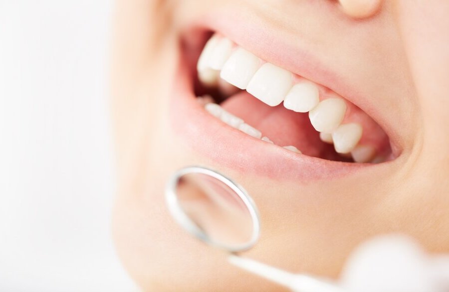 Zahnfarbene Füllungen aus Komposit – für kleinere Kariesschäden - Zahnarzt Köln