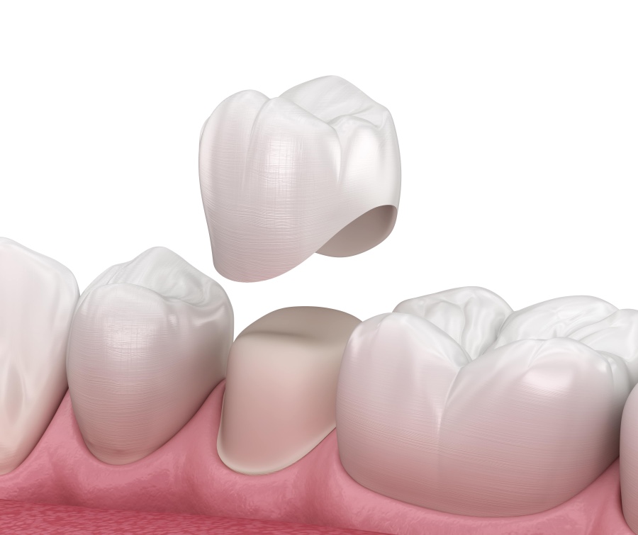 Zahnkrone und Teilkrone Köln – ästhetisch und funktional bei Dr. Sales