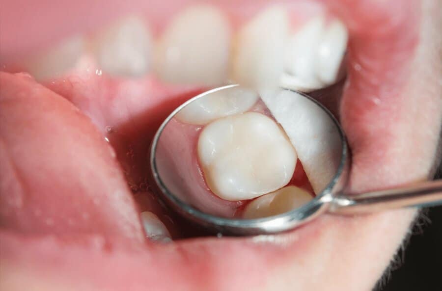 Füllungen mit hochwertigen, gesunden Materialien bei Zahnarzt Dr. Sales in Koeln